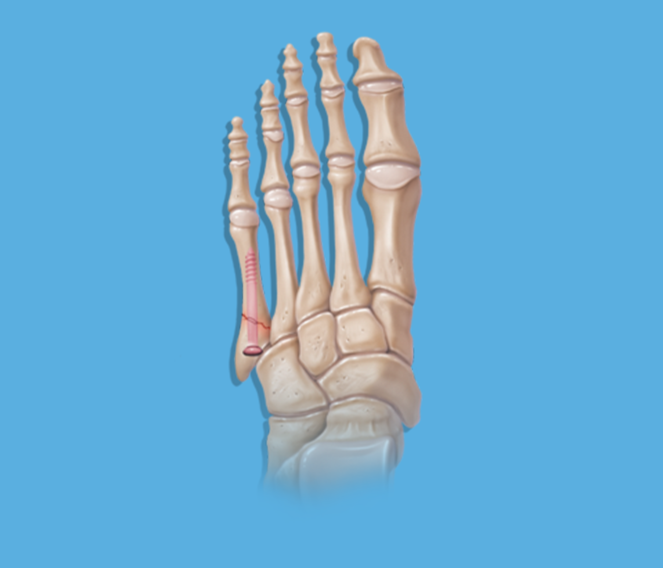 Fratura do 5º Metatarsal / Blog Jaleko