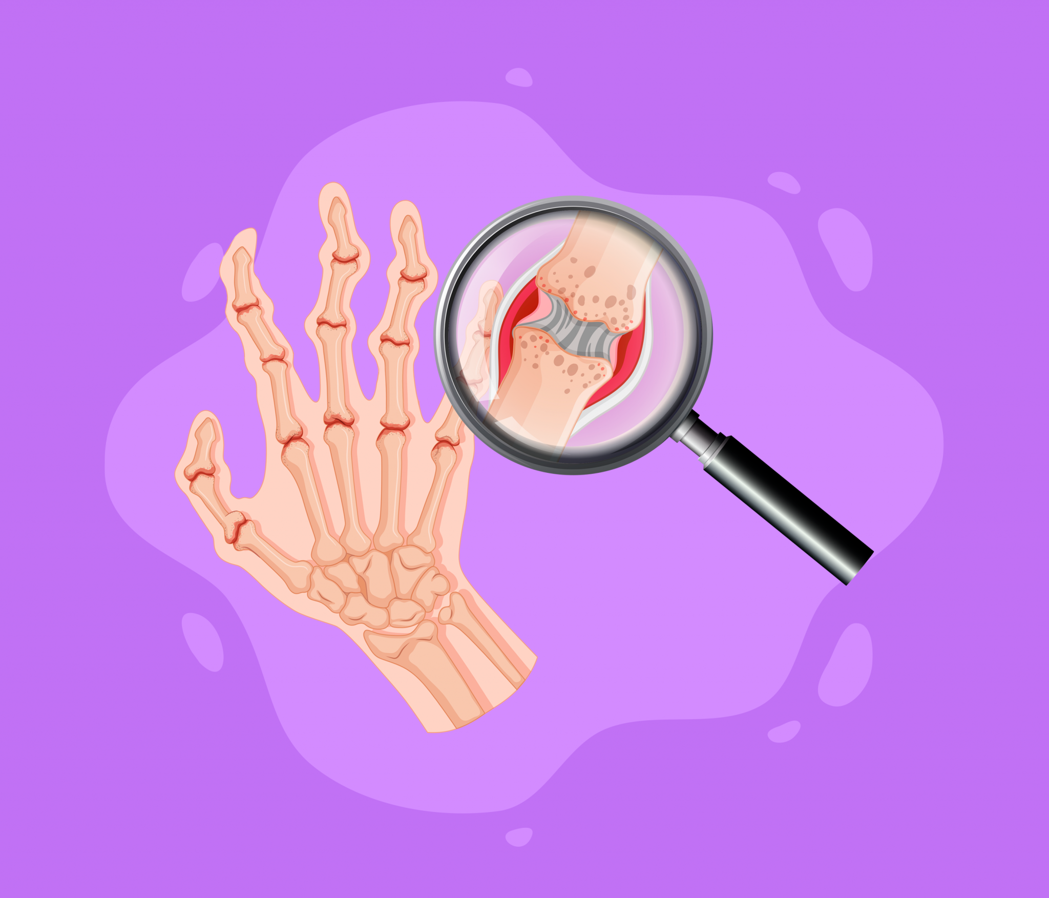 Artrite Reumatoide quais são os principais sinais e sintomas? Artrite Reumatoide quais são os principais sinais e sintomas?